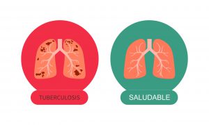 Tuberculosis