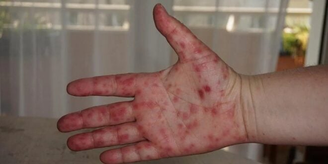 Virus-de-coxsackie-¿Como-se-contagia-cuales-son-los-sintomas-y-como-prevenirlo-660x330